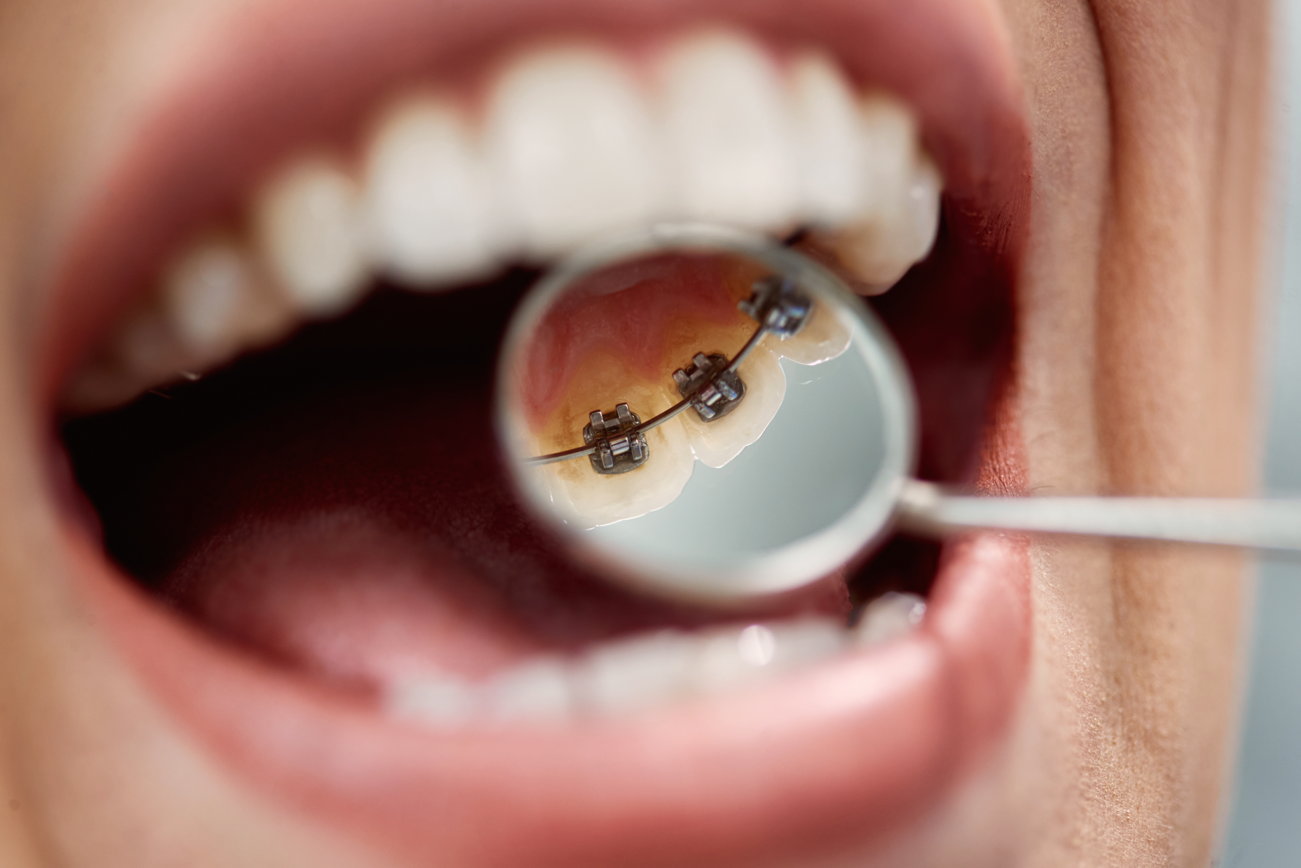 Lingual Braces or Hidden Braces