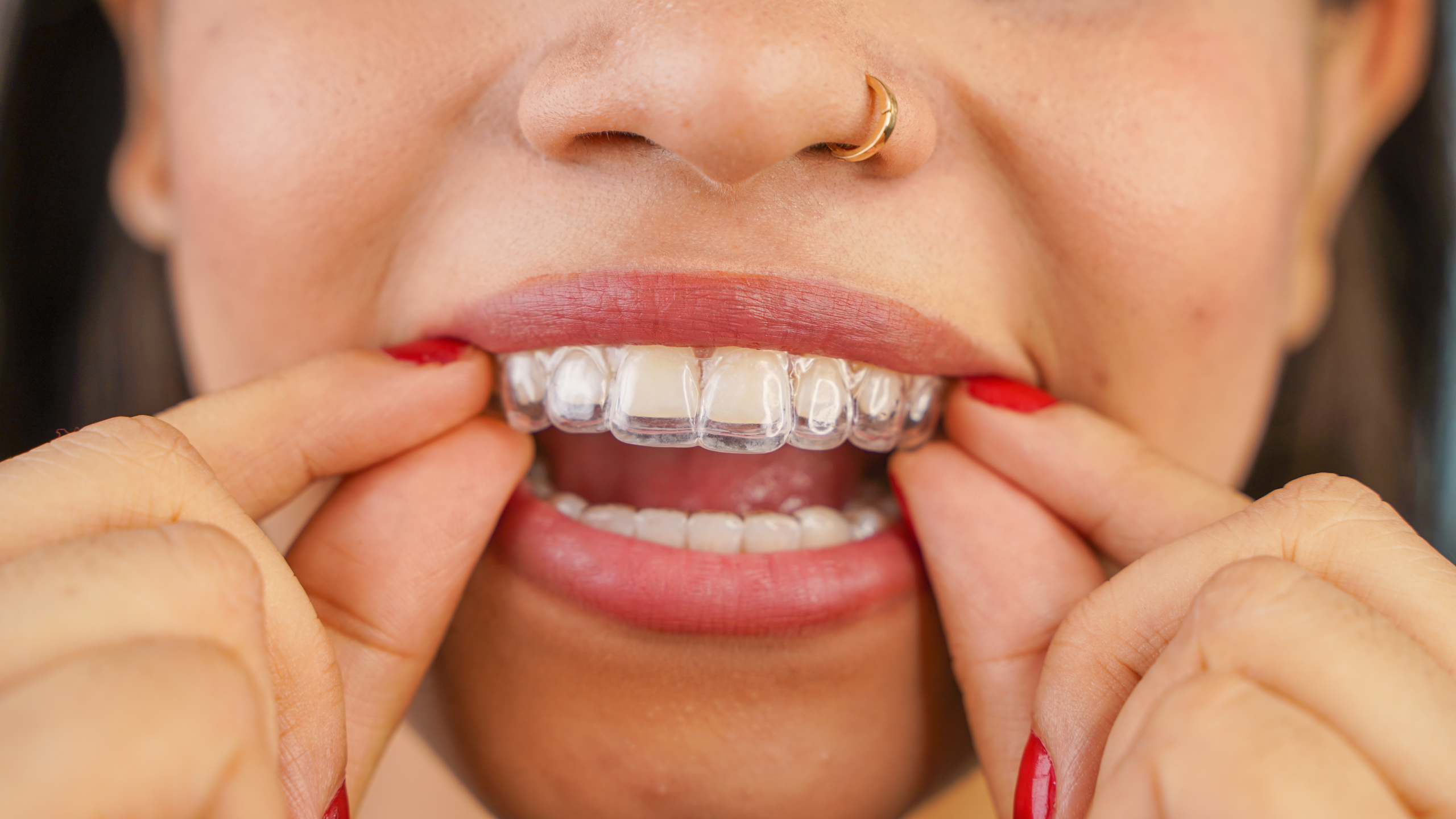 girl with nose ring putting in aligners